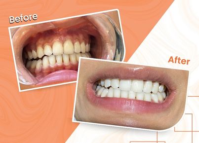 Teeth cleaning